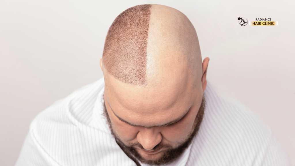 hair transplant advantages