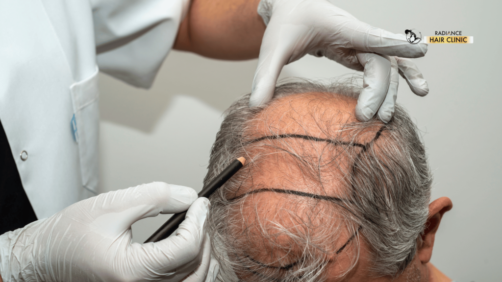 Can Hair Transplant Cause Cancer